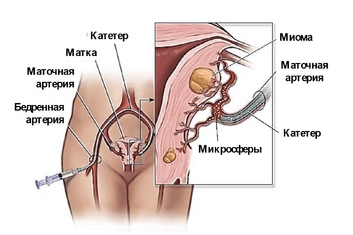 Операции по лечению миом матки методом эмболизации маточных артерий (ЭМА)