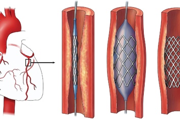 Эндоваскулярные методы лечения заболевания артерий