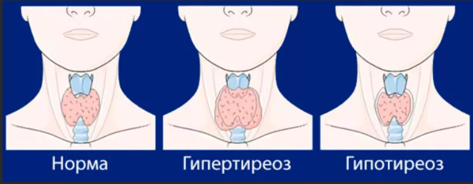 Заболевание щитовидной железы гипертиреоз. Гипотиреоз и гипертиреоз щитовидной железы. Щитовидная железа тиреотоксикоз гипертиреоз. Норма щитовидной железы у детей.
